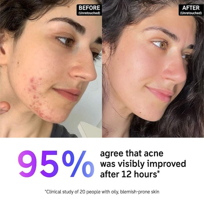The INKEY List Acne Cream - 0.5 oz/15 ml