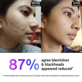 The INKEY List Acne + Blackhead Cleanser - 5 oz/150 ml