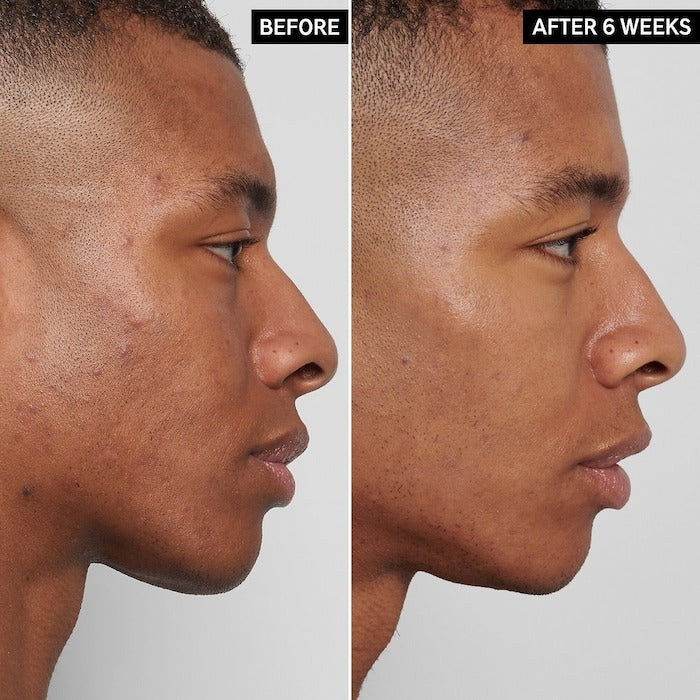 Tratamento para Manchas Escuras, Acne e Imperfeições da The INKEY List - 0.5 oz/15 ml
